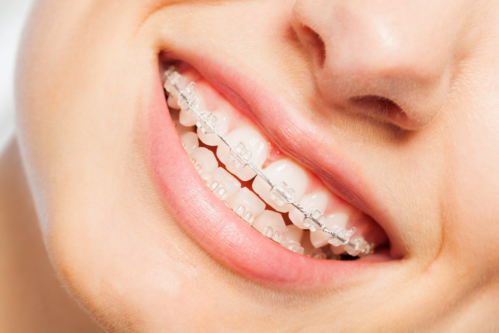 top-ceramic-braces-orthodontics-chennai